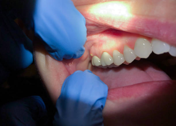Best Urgent Tooth Repair  in Madison, MN